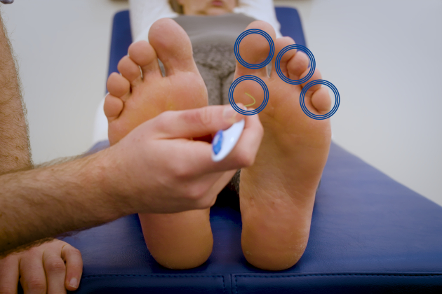 Image shows close up on soles of patient's feet. Nurse uses monofilament to test sites on the foot which are identified by blue circles 