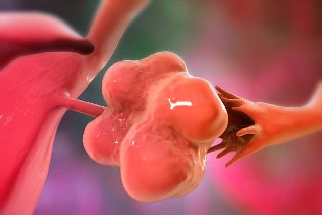 A computer illustration shows an enlarged left ovary with cysts, representing a story on polycystic ovary syndrome, known as PCOS